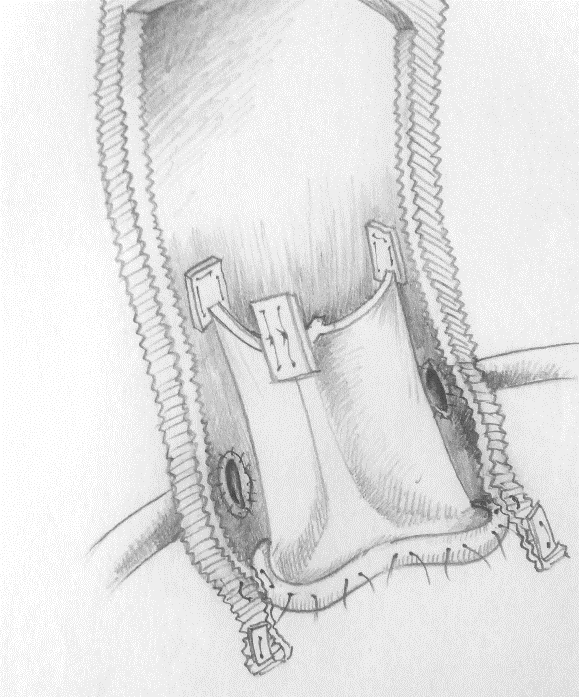 Long-term Results of Stentless Bio-Conduits for Bentall Operation