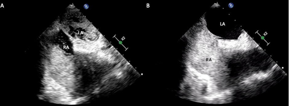 Persistent Left Superior Vena Cava with Unusual Drainage