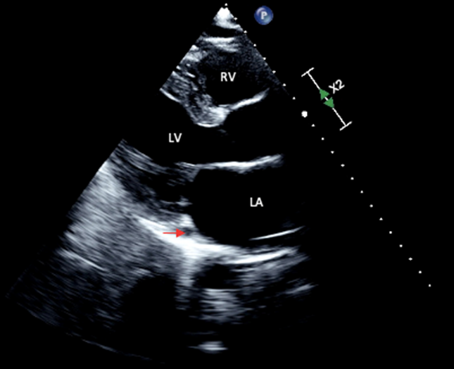 Persistent Left Superior Vena Cava with Unusual Drainage