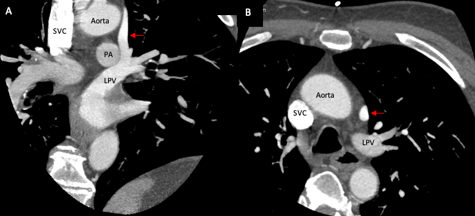 Persistent Left Superior Vena Cava with Unusual Drainage